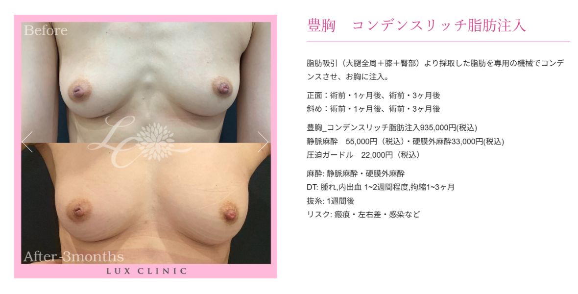 コンデンスリッチ脂肪注入 豊胸