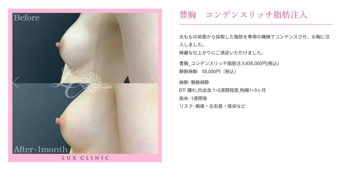 コンデンスリッチ脂肪注入 豊胸