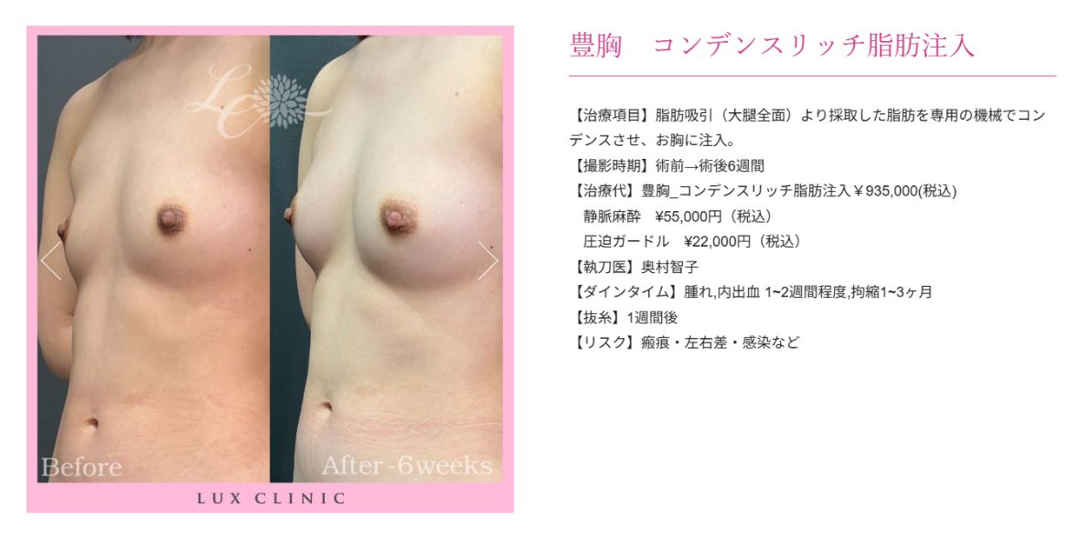 コンデンスリッチ脂肪注入 豊胸