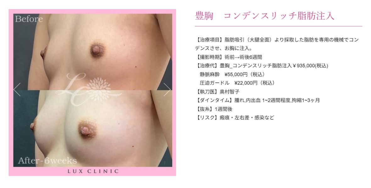 コンデンスリッチ脂肪注入 豊胸