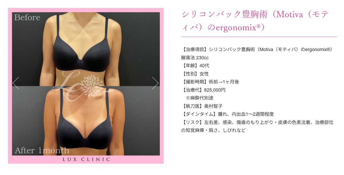 シリコンバック豊胸