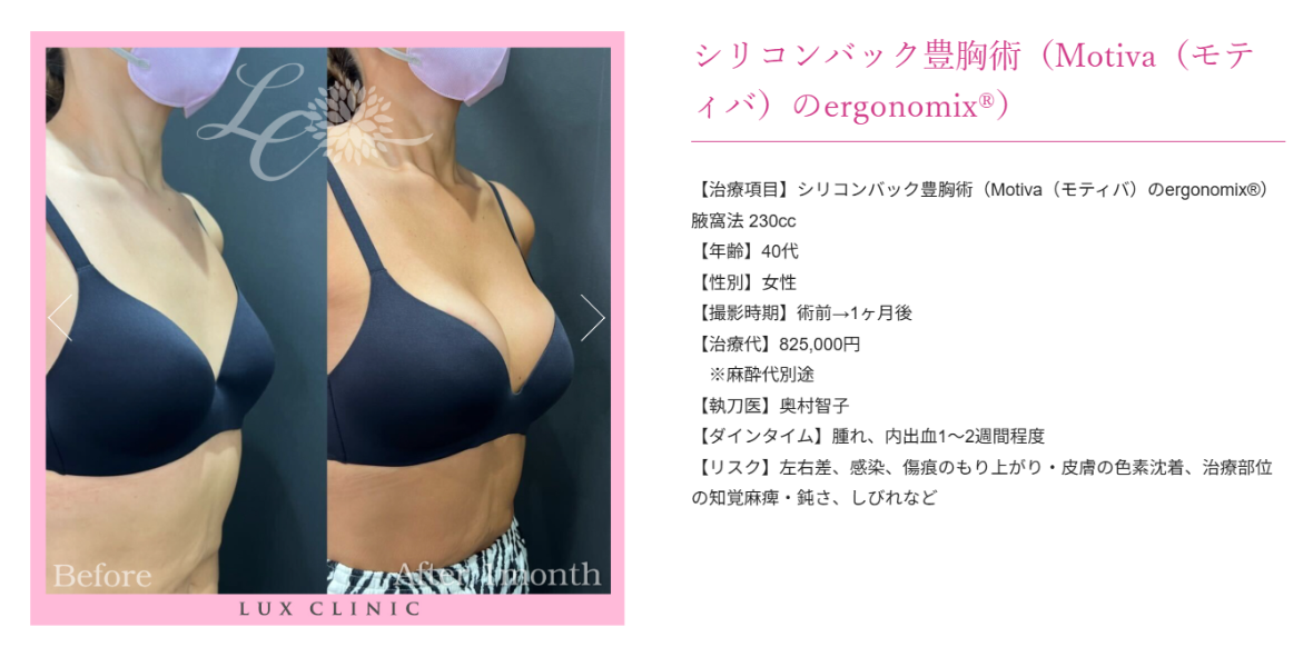 シリコンバック豊胸