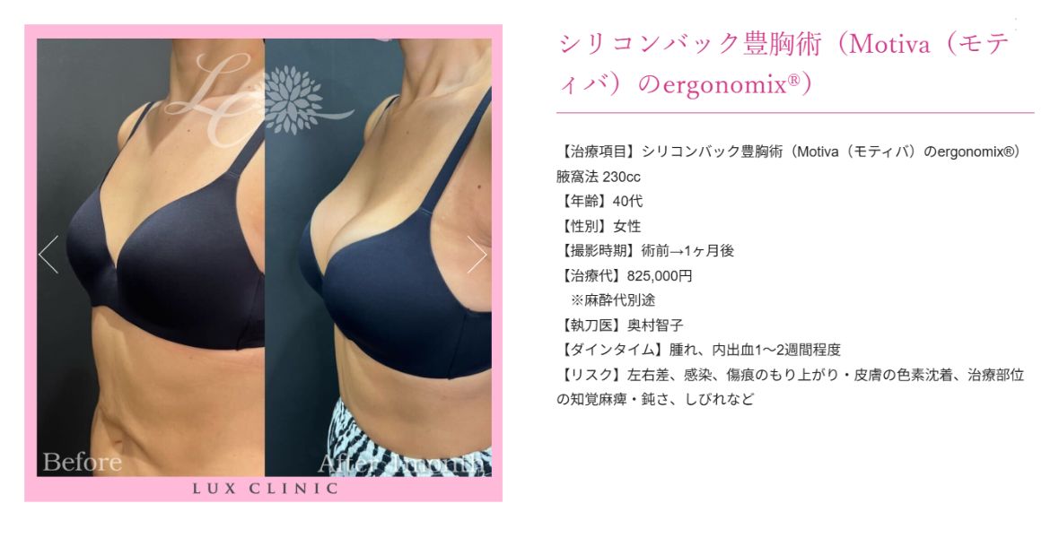 シリコンバック豊胸