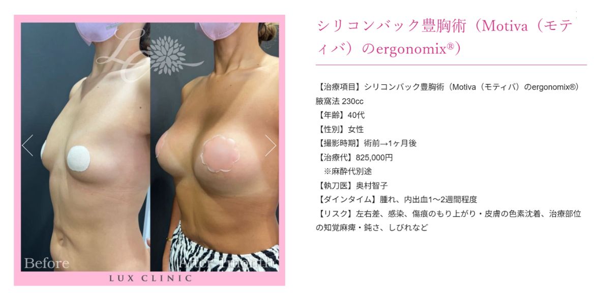 シリコンバック豊胸