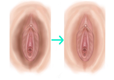 デリケートゾーン あそこの黒ずみ ピーリング