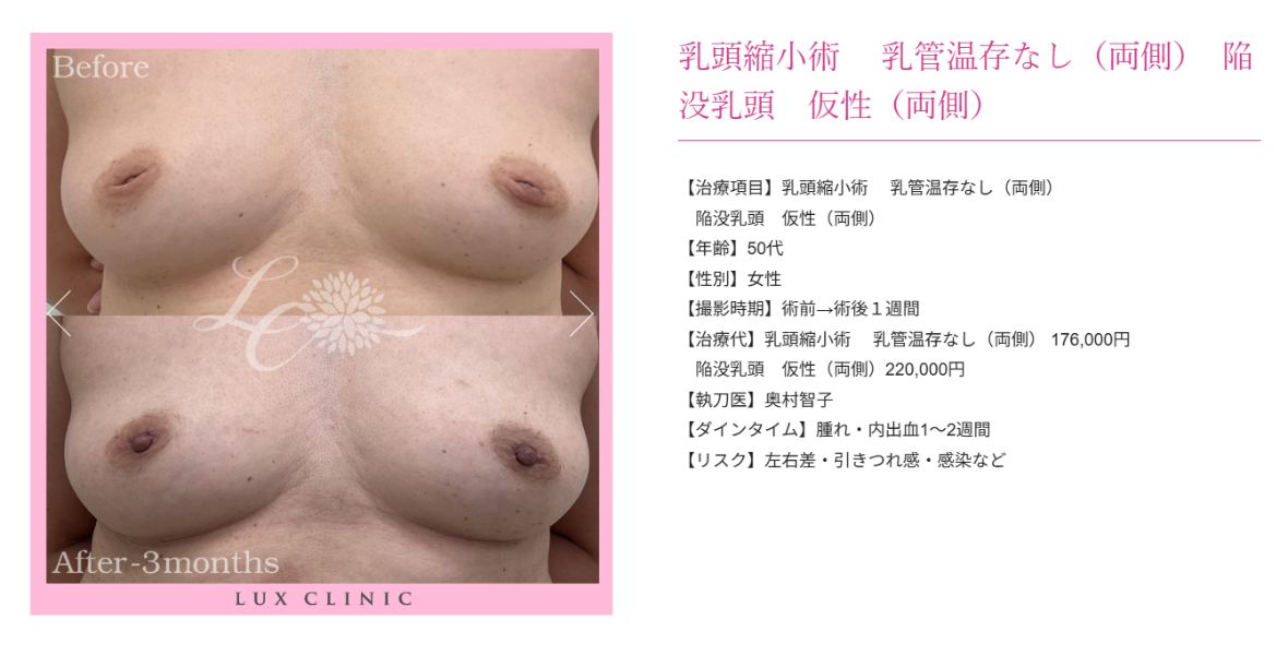 乳頭縮小術 陥没乳頭