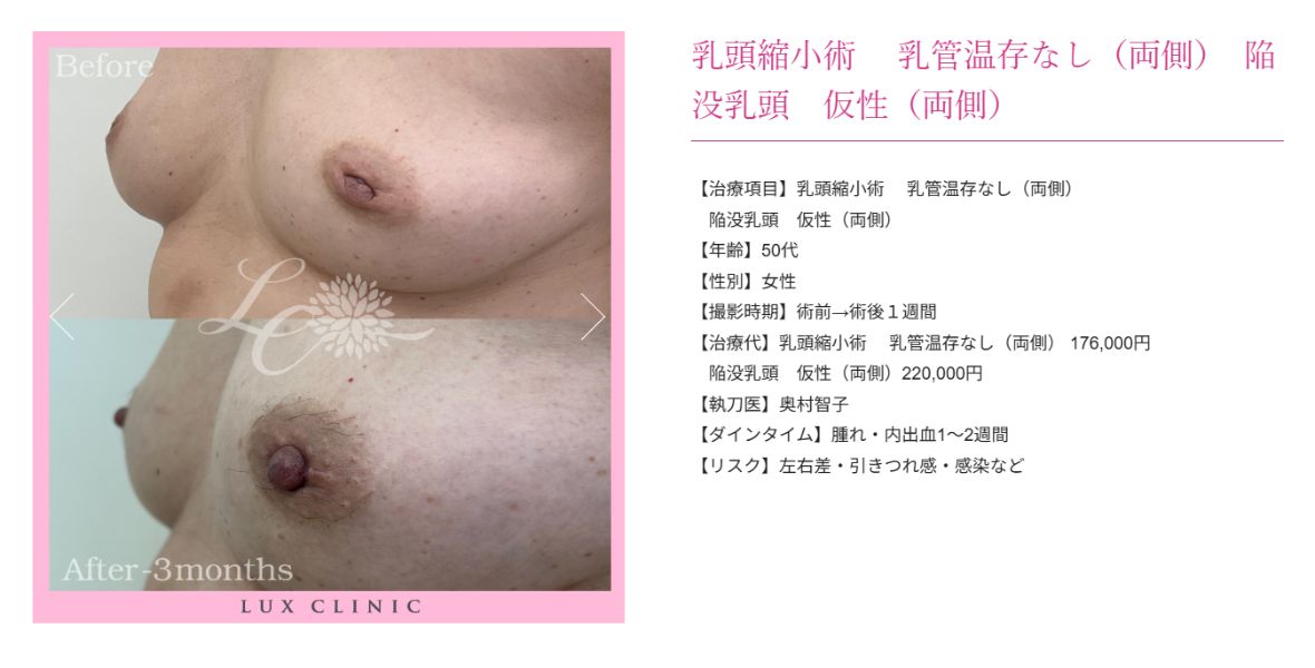 乳頭縮小術 陥没乳頭