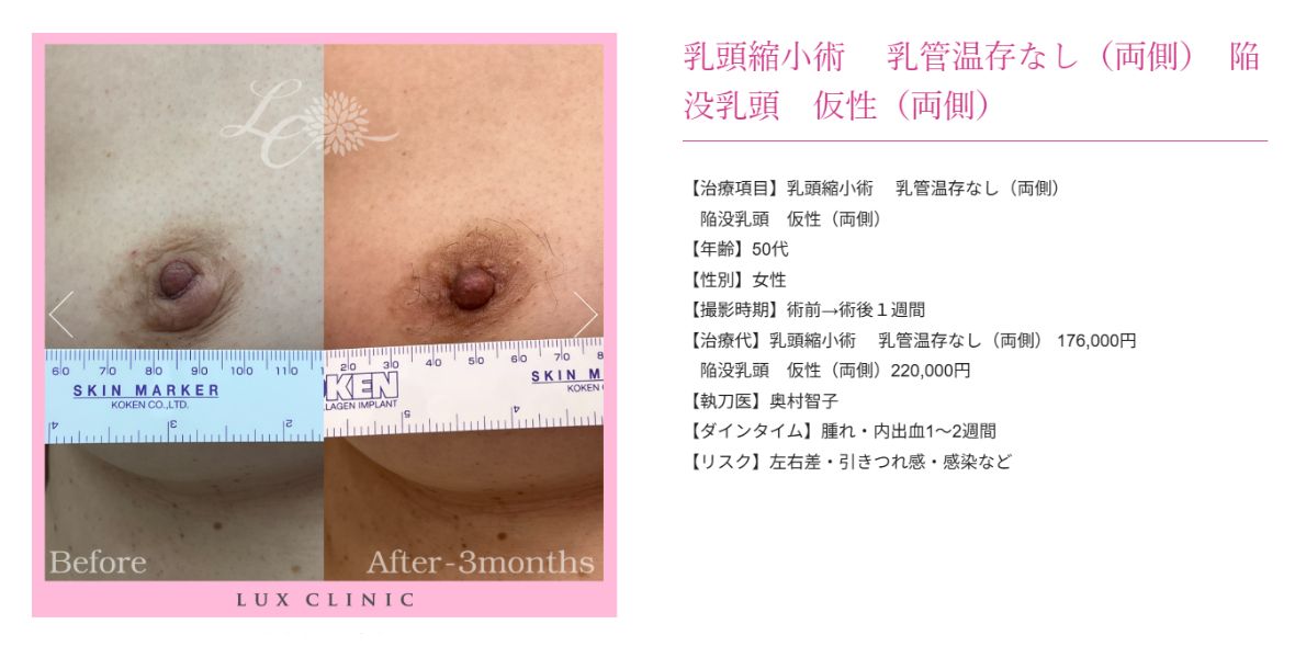 乳頭縮小術 陥没乳頭