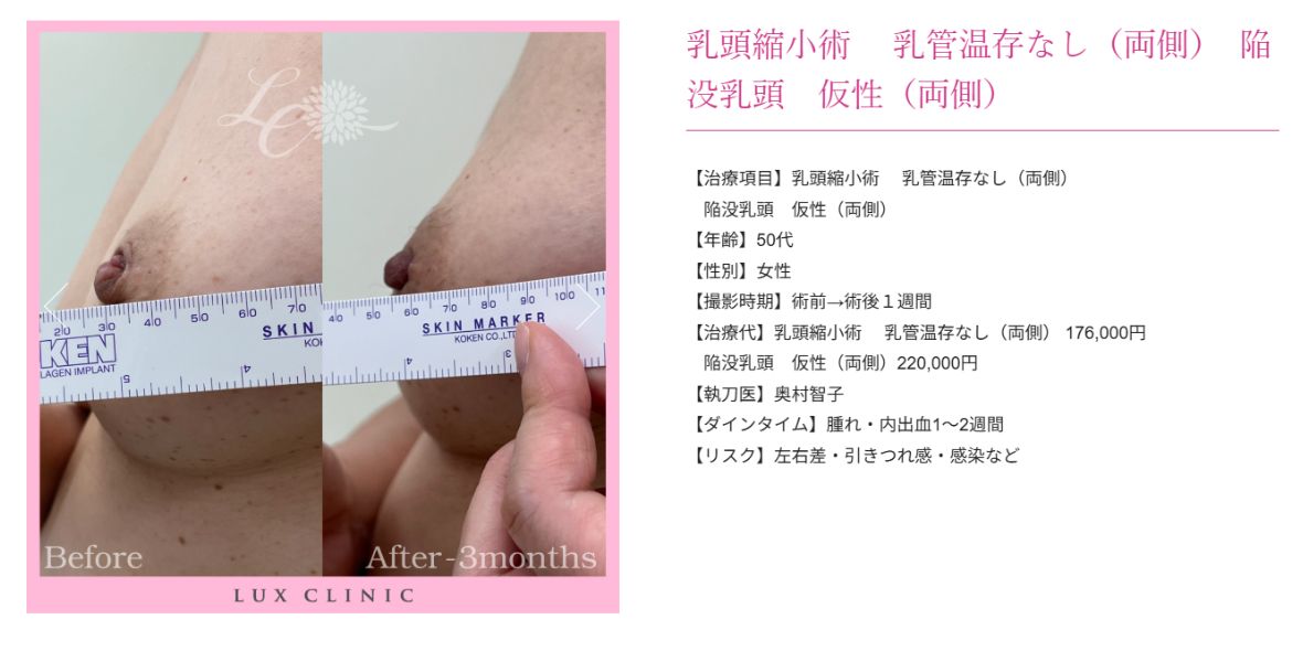 乳頭縮小術 陥没乳頭