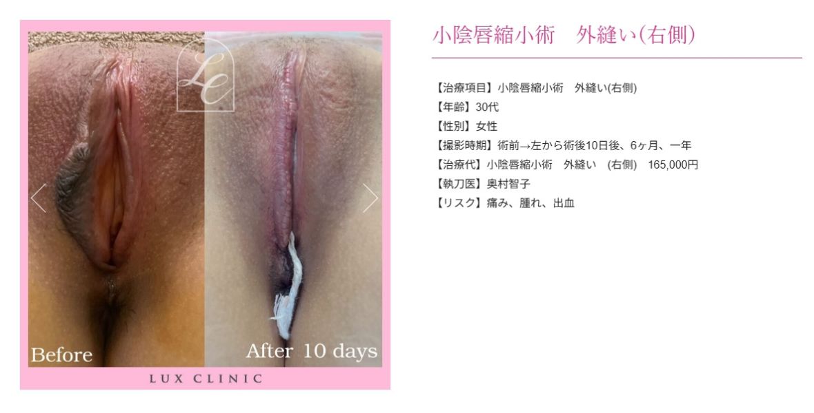 小陰唇縮小術