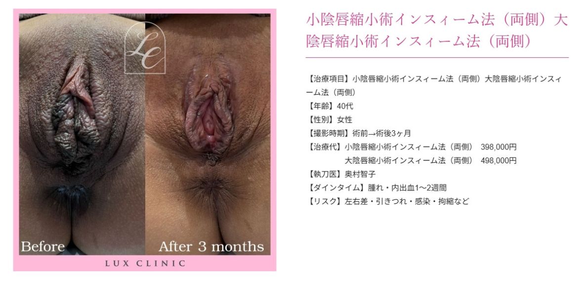 小陰唇縮小術インスィーム法 大陰唇縮小術インスィーム法