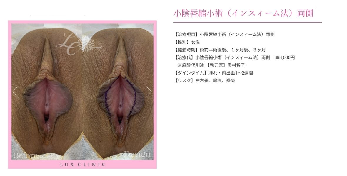 小陰唇縮小術 インスィーム法