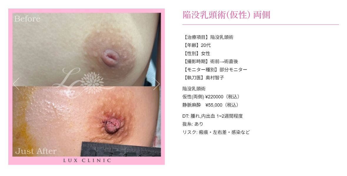陥没乳頭術
